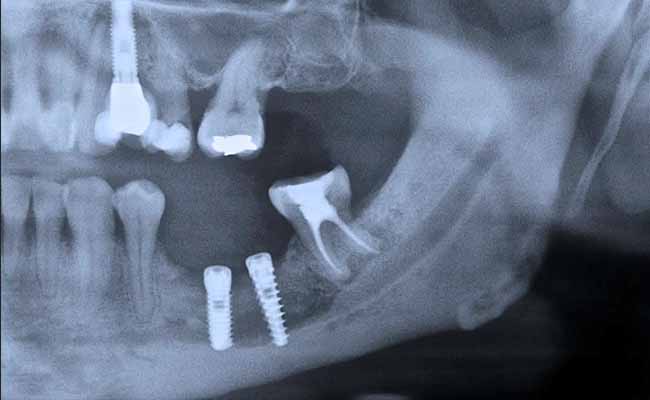 Wrong placement -Dental Implant x-rays