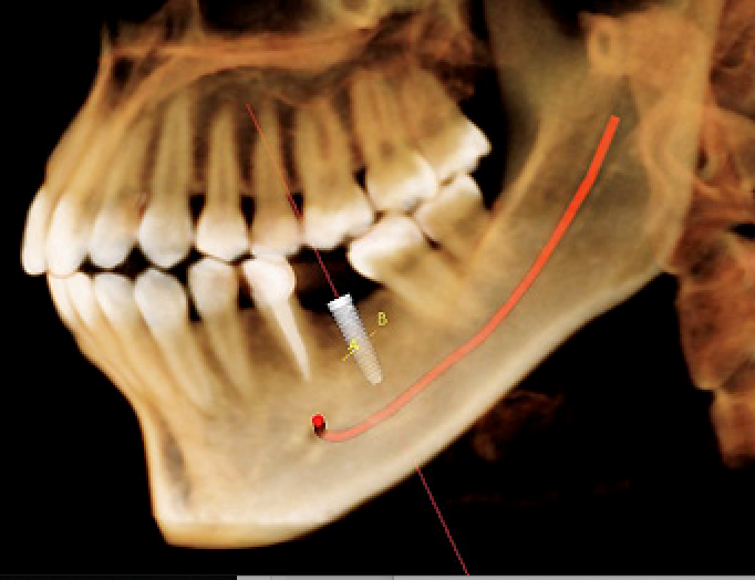 proper placement of dental implant